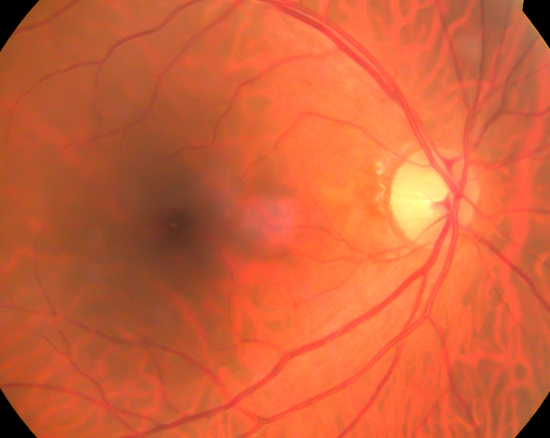 Rare Ophthalmologic