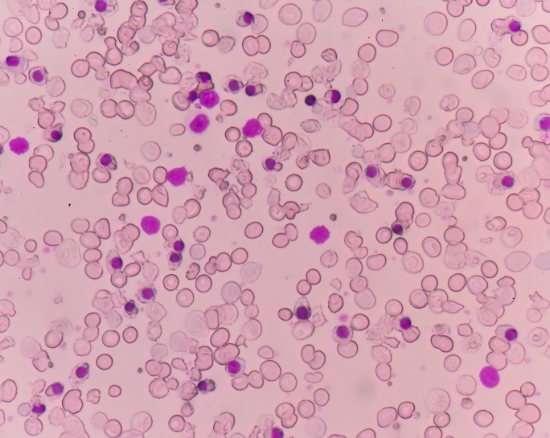 Rare Hematologic